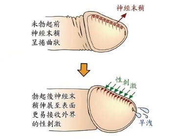 厦门包皮过长激光手术